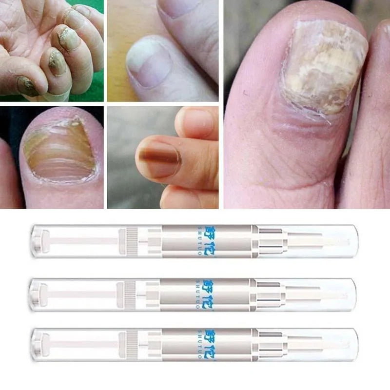 Fungus Treatment Repair Pencil